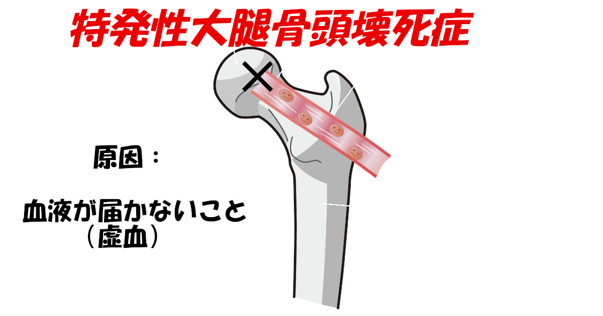 堀ちえみさんが特発性大腿骨頭壊死症で人工関節手術 いい医者 Com